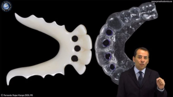 Maxillary Delayed Placement and Conventional Loading