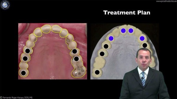 Prosthetic Soft Tissue Management