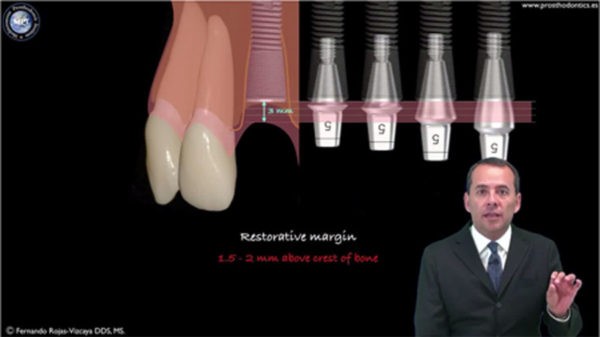 Single Implants