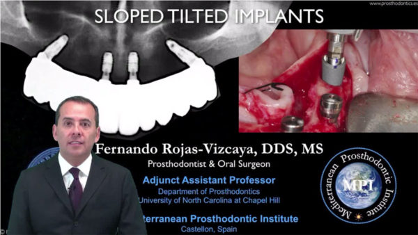 Sloped tilted Implants for Bi-maxillary Monolithic Zirconia Restorations