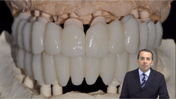 Cement Monolithic/Veenered Zirconia Implant Supported CAD/CAM Fixed Full Mouth Restorations