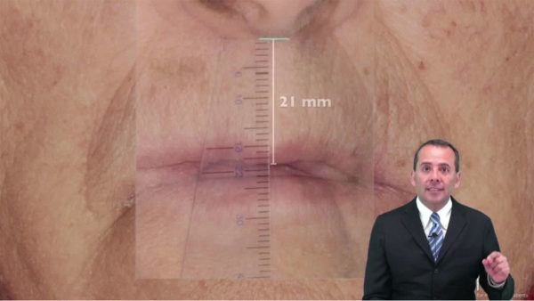 Photo Smile Design for Edentulous Patients