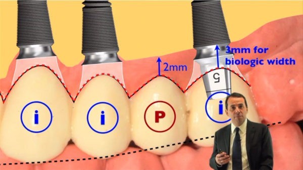 Immediate Placement and Immediate Loading for Fully Maxillary Rehabilitation